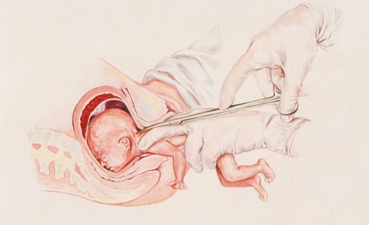 Diagram of partial-birth abortion procedure